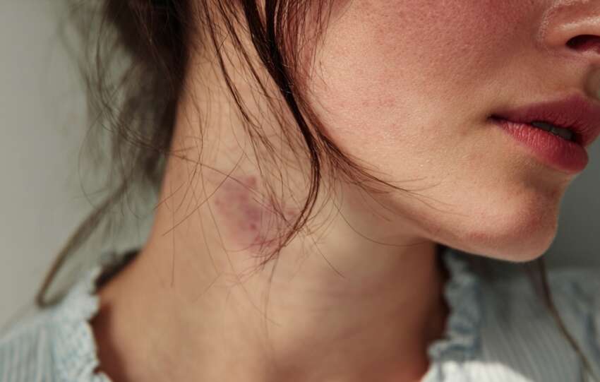 Pourquoi les suçons peuvent nuire à votre santé ?